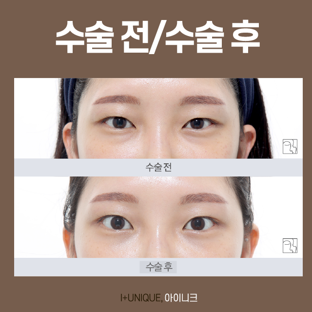 오늘 수술 내일 출근할 수 있는 눈밑지방수술 관련 이미지 5