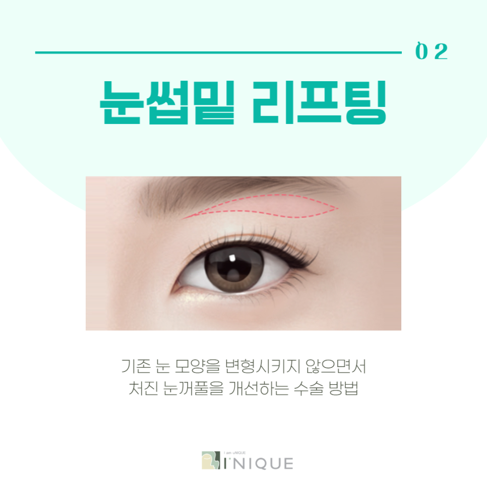 중년눈수술로 다시 20대의 눈매로 관련 이미지 3
