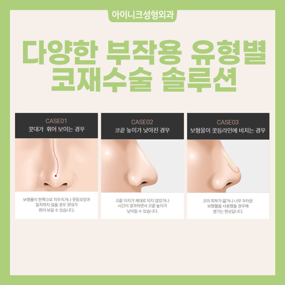 코재수술유명한병원 부작용에 따른 맞춤 솔루션을 찾자 관련 이미지 4