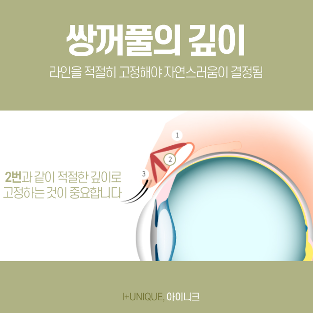 티안나는쌍꺼풀을 만들기 위한 방법? 관련 이미지 4