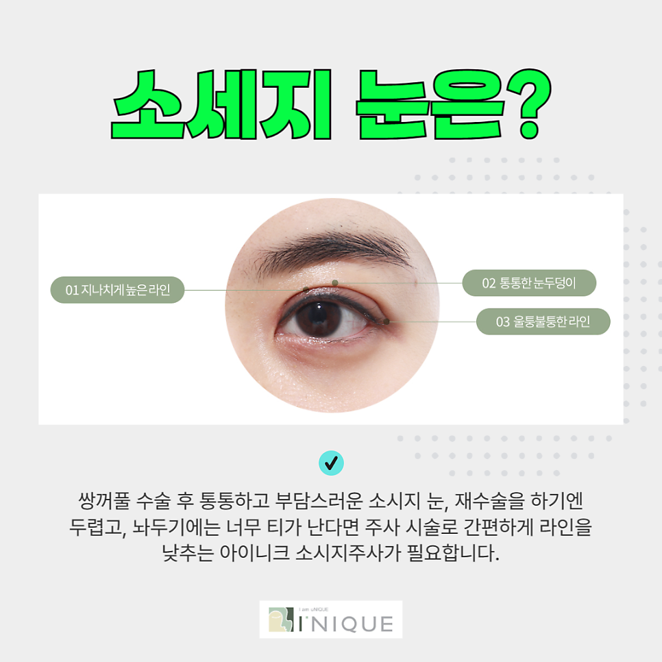 Double Eyelid Scar Tissue Removal, Easily Resolved with an Injection image 5
