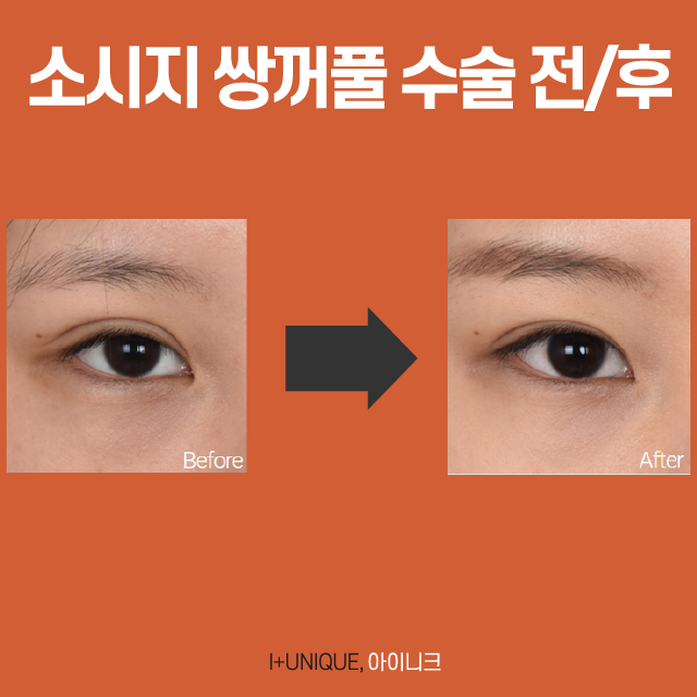 소세지눈 더 이상 고민 NO! 자연스러운 눈매를 위한 소세지 쌍꺼풀 수술 관련 이미지 4