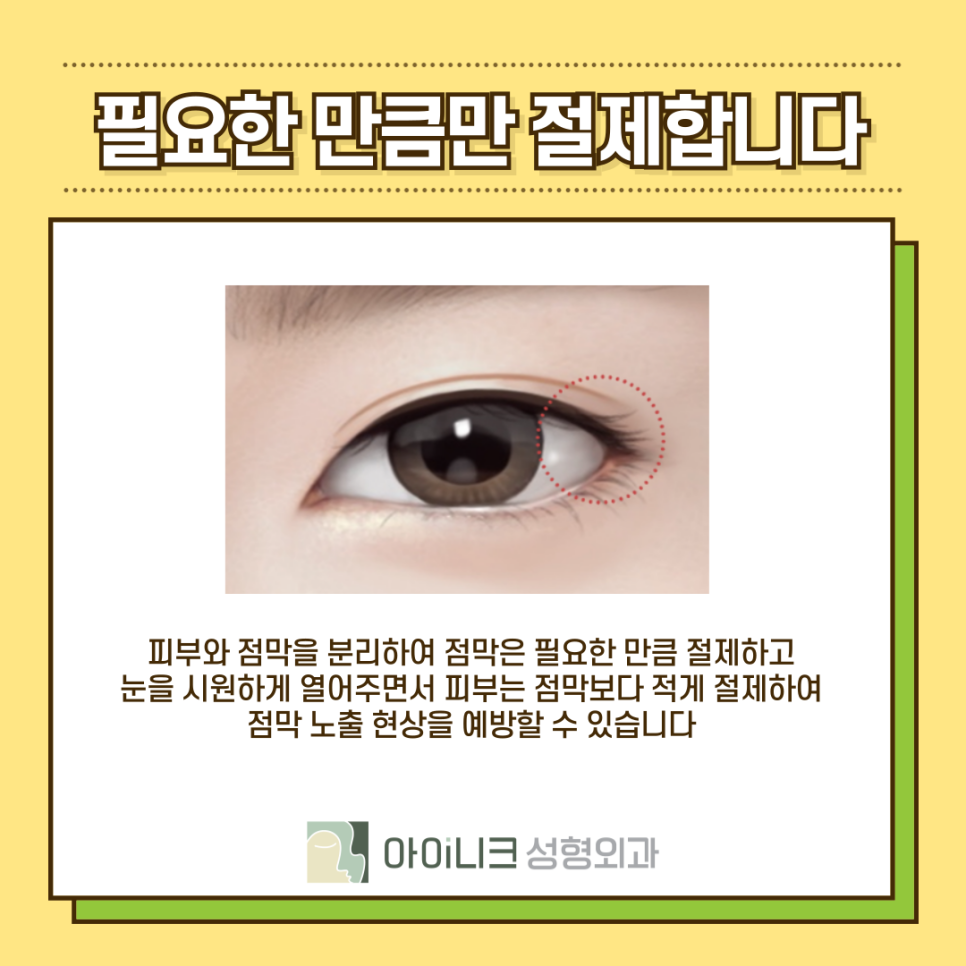 밑트임뒷트임 원하는 눈매에 맞게 진행하기 관련 이미지 10