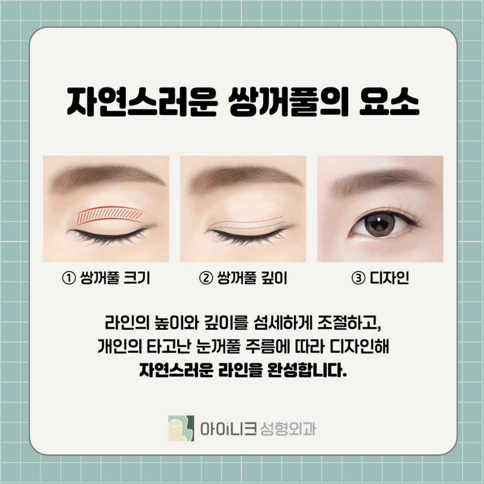 강남눈성형 자연스럽게 하려면 관련 이미지 4