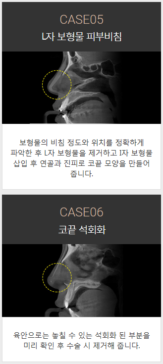 코보형물종류 나에게 맞는 걸로 선택하자 관련 이미지 4