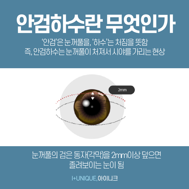 졸린눈고민 방치하면 위험할수도 있습니다 관련 이미지 5