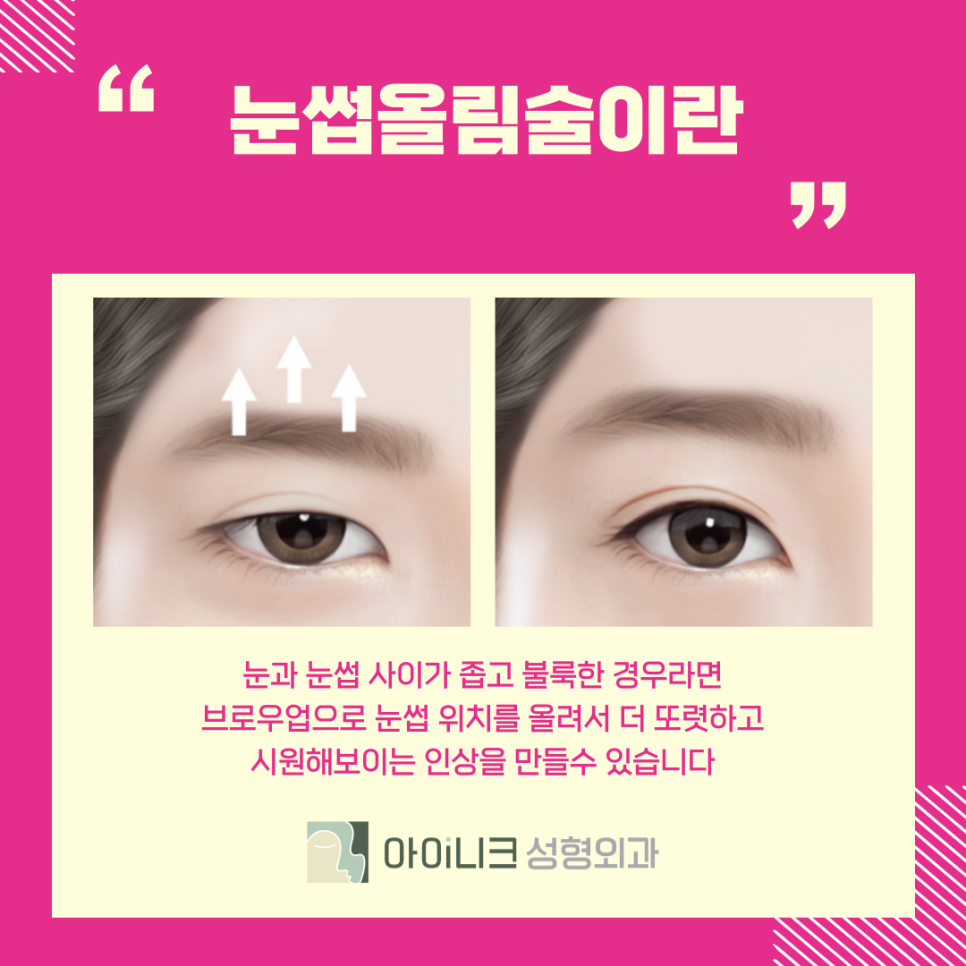 Why Is Brow Lift Surgery Needed in Apgujeong Eye Plastic Surgery? image 7