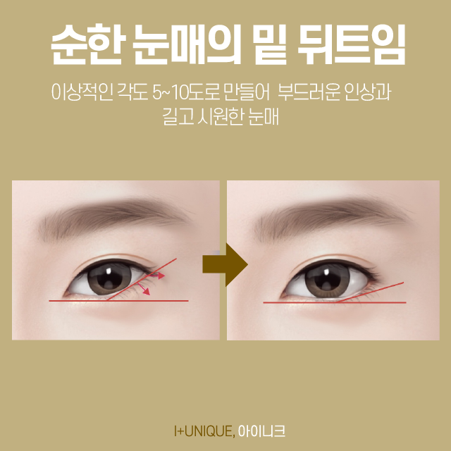 눈성형외과유명한곳 그 중, 자연스러운 트임을 원한다면? 관련 이미지 5