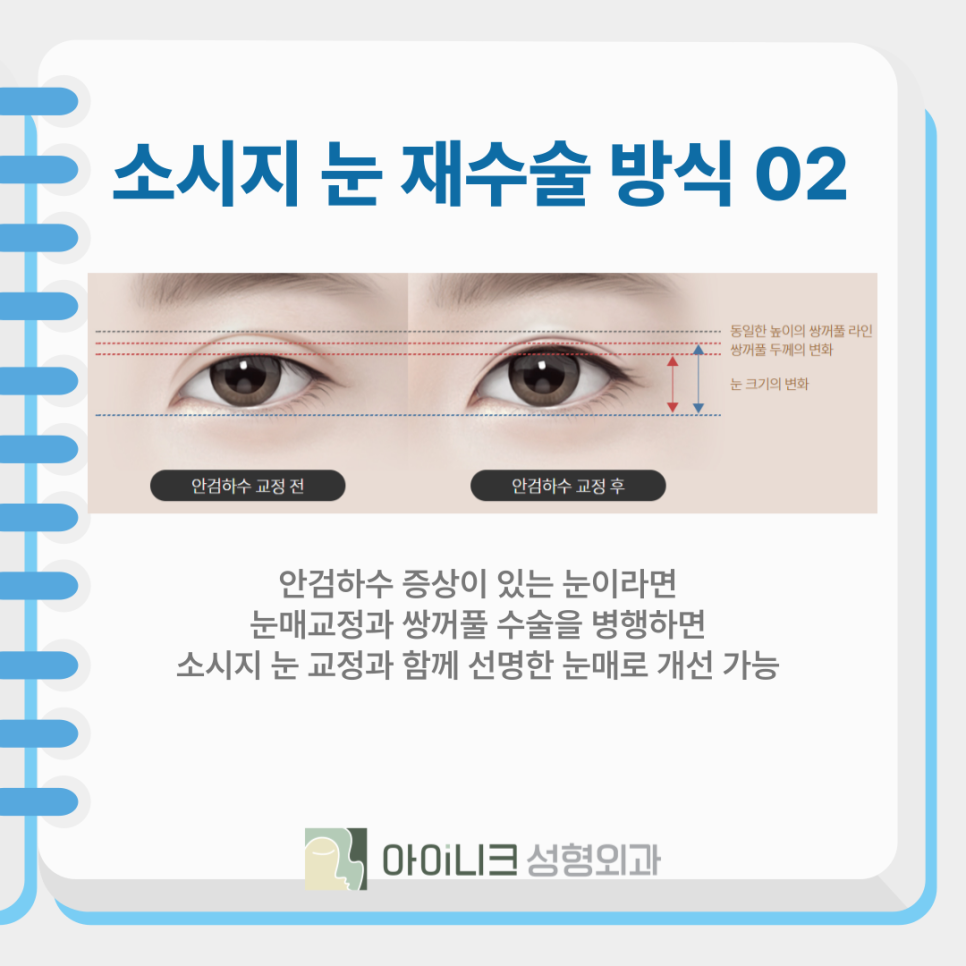쌍꺼풀재수술비용과 함께 꼼꼼하게 따져야 할 것 관련 이미지 9
