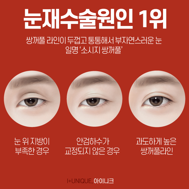 눈 재수술을 알아보고 있다면 압구정동성형외과 아이니크에서! 관련 이미지 2