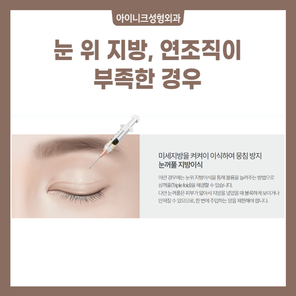 여러겹쌍꺼풀 해결방법을 정확히 알고 싶다면? 관련 이미지 5