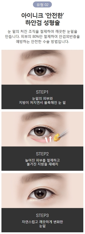 하안검수술가격 합리적인 아이니크에서 동안 얼굴로 개선! 관련 이미지 4