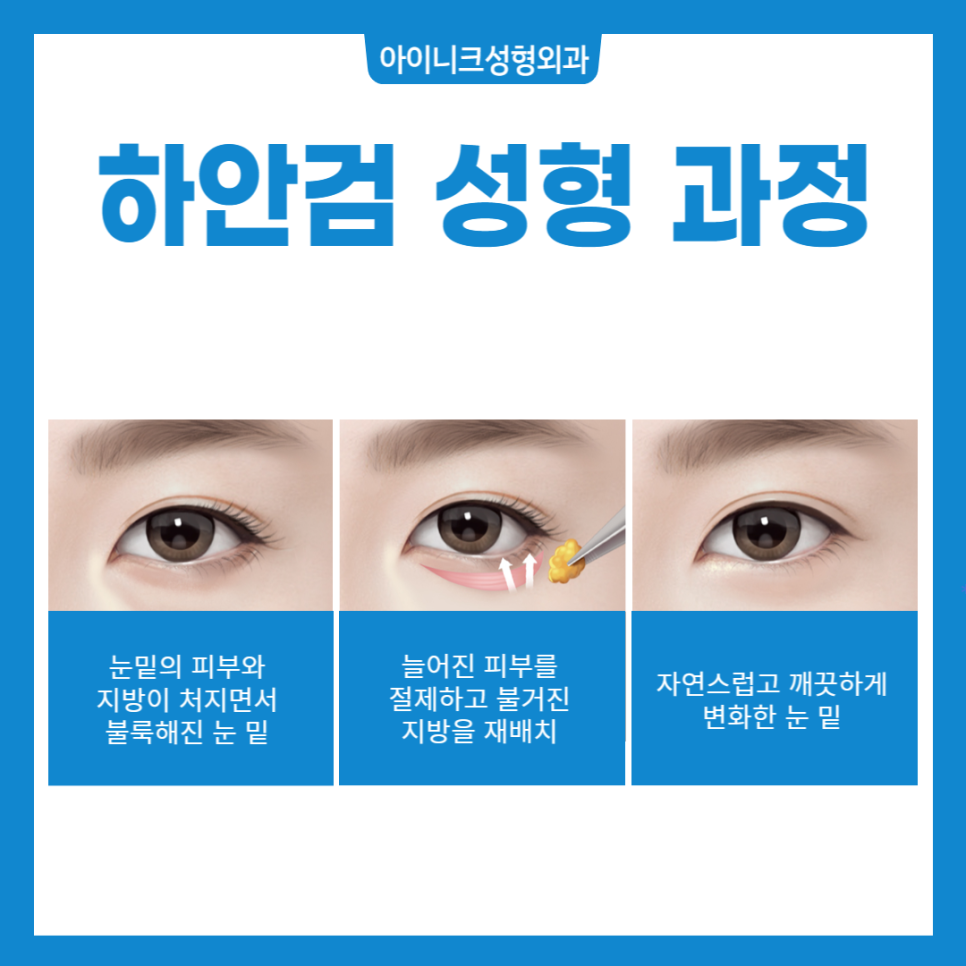 Sagging Eye Surgery: Just Remember These Two Things! image 4