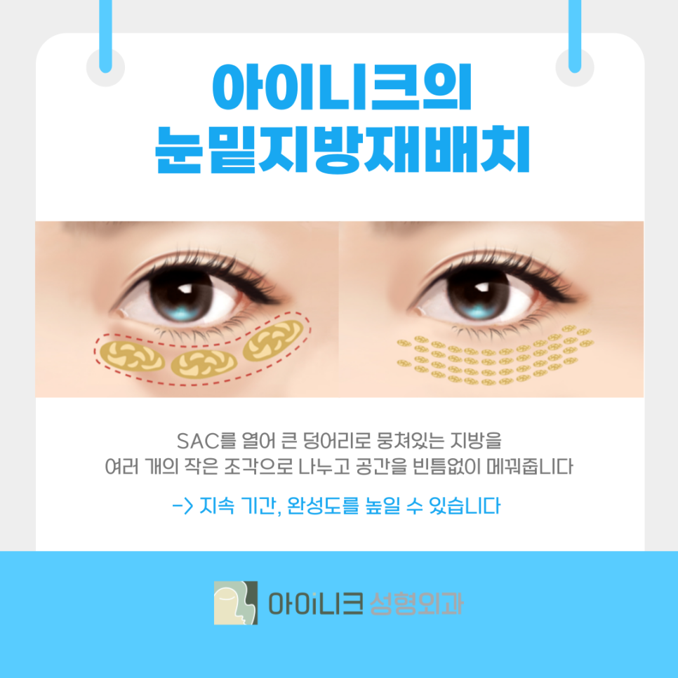압구정 눈밑지방재배치 SAC에 집중하는 방식이란? 관련 이미지 5