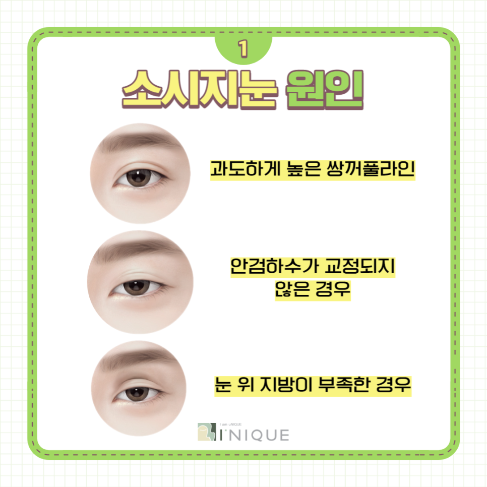 쌍꺼풀라인낮추기 가장 중요한 것은 병원선택! 관련 이미지 2