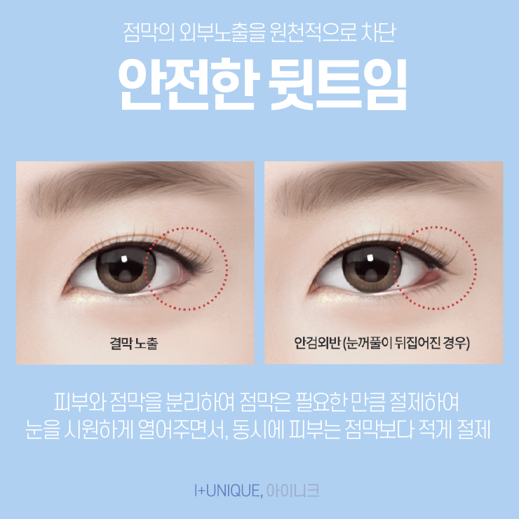 눈트임수술 어떤 것을 해야할지 고민이라면 아이니크성형외과에서 상담받자 관련 이미지 4