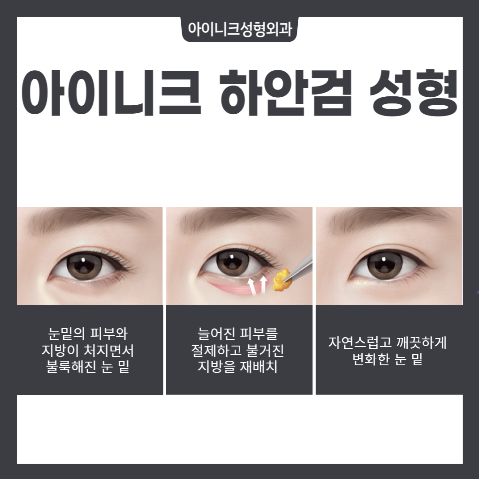 중년성형, 다시 20대의 눈매로 관련 이미지 4