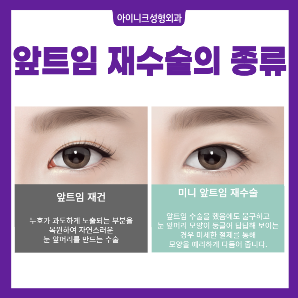 앞트임재수술잘하는곳, 여기! 관련 이미지 2