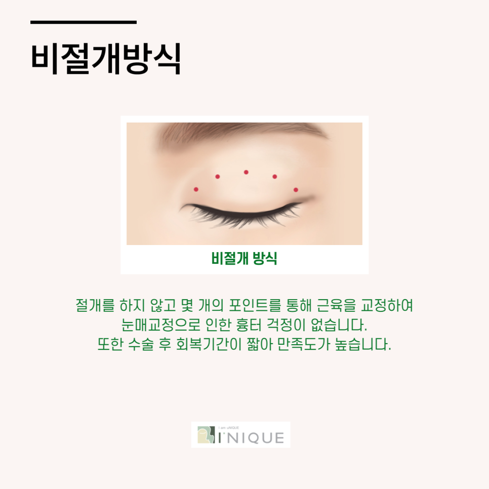 남자속쌍눈매교정 성공하는 법 관련 이미지 5