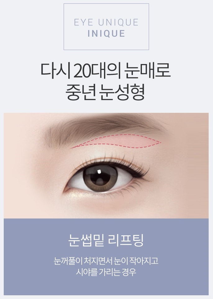 상안검성형술로 다시 20대의 눈매! 관련 이미지 2