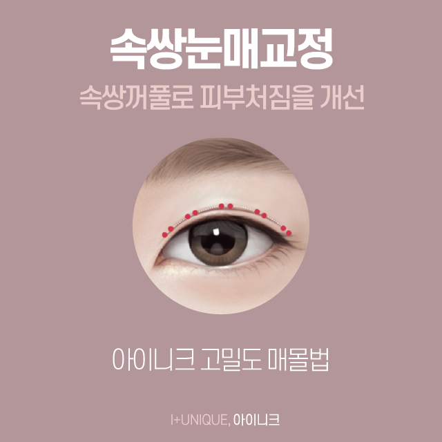 남녀노소 가능한 눈매교정술 그리고 가격까지 한 번에 알아보자! 관련 이미지 4