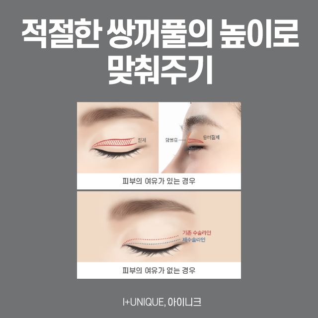 Sausage Double-Eyelid Correction: There Is No Second Failure! image 3