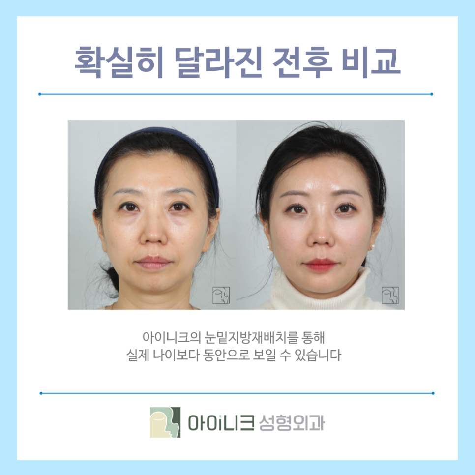 신사역근처눈밑지 동안 페이스로 만들기 관련 이미지 6