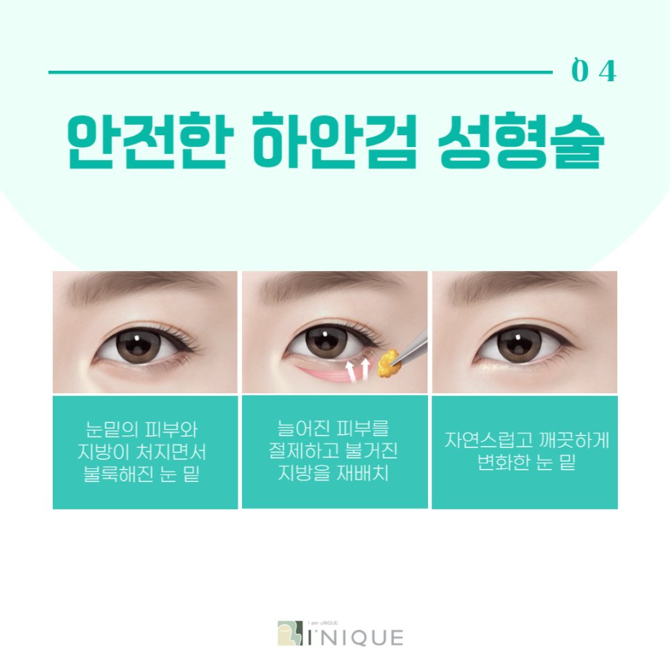 중년눈수술로 다시 20대의 눈매로 관련 이미지 5