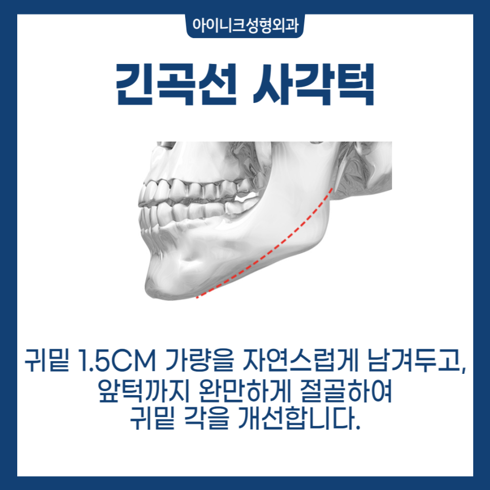 자연스러운 V라인 사각턱성형 관련 이미지 2
