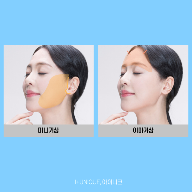 Finding the Right Revision Facelift Method for Me, from the Face to Under the Chin image 3