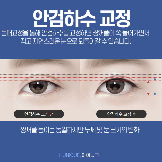 통통해서 부담스러운 내 눈, 쌍꺼풀라인낮추기로 처음부터 내 눈이였던 것처럼 관련 이미지 4