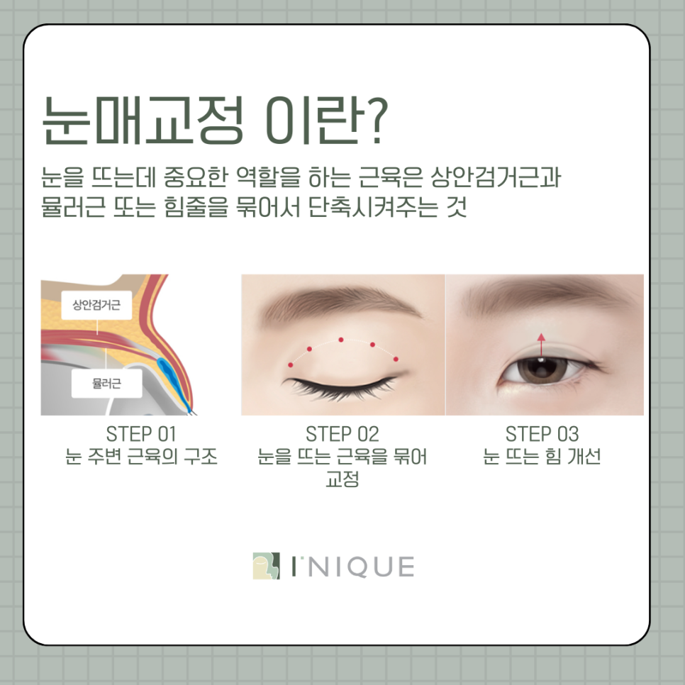 강남 눈매교정 이렇게 하면 자연스러워요 관련 이미지 5