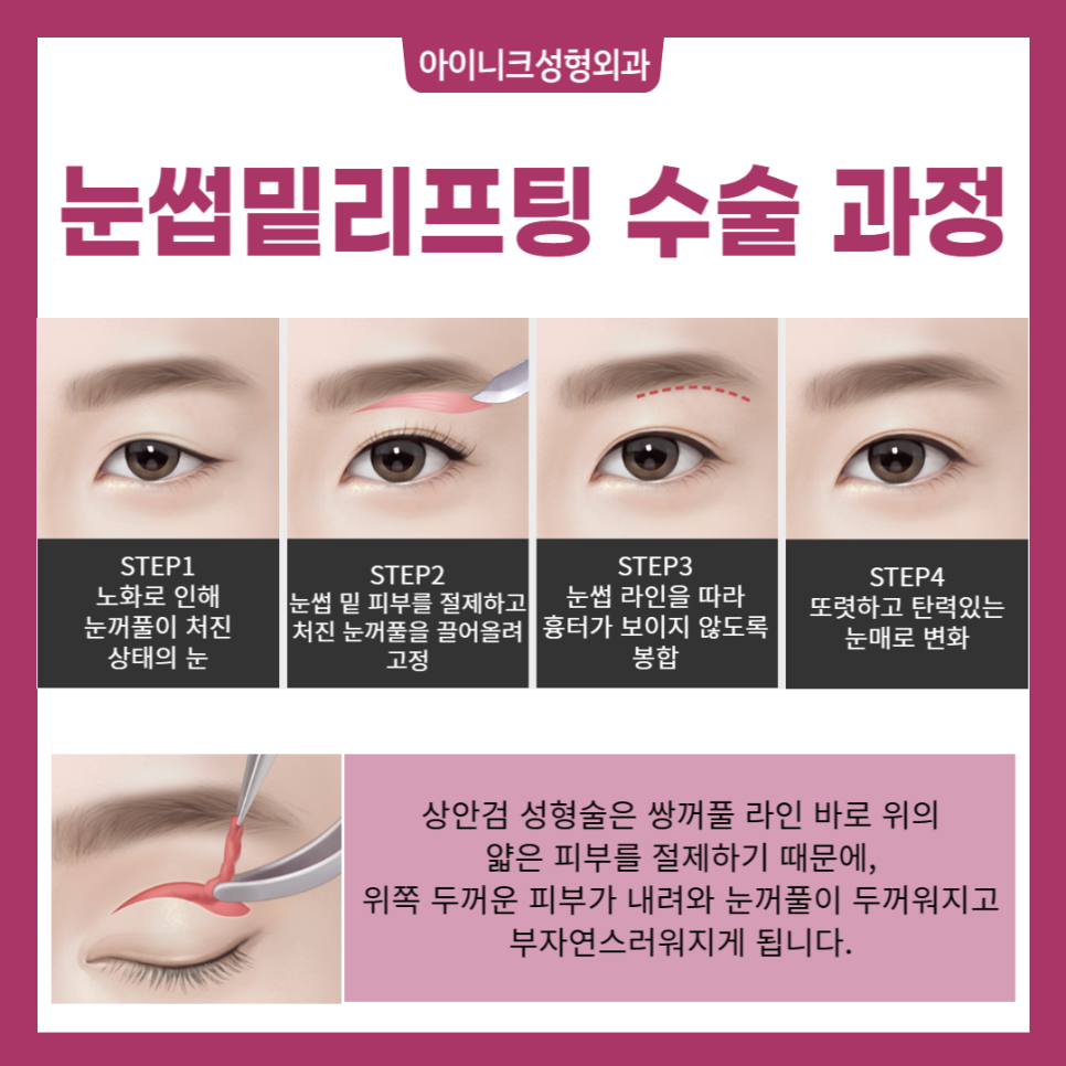 Lower Blepharoplasty for the Under-Eye Area, Safe and Successful image 4