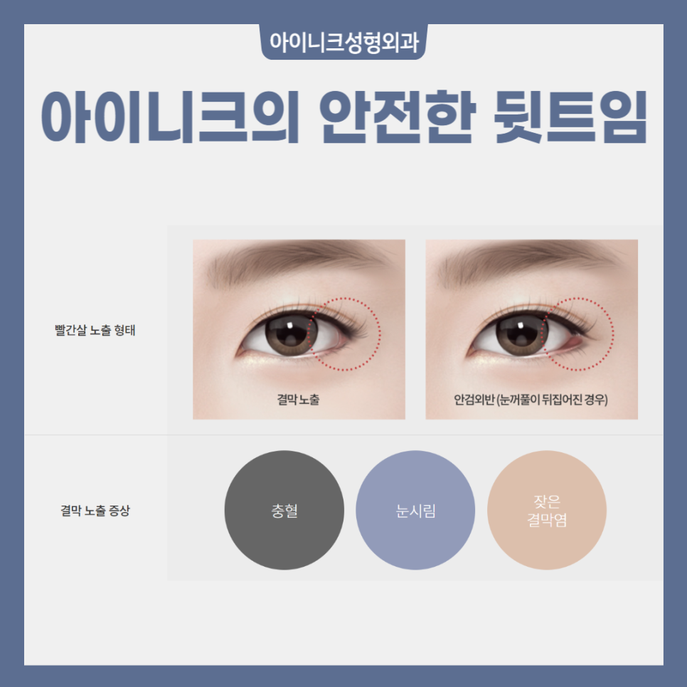 The Secret to a Natural, Clear Eye Shape with Outer Corner Surgery image 4