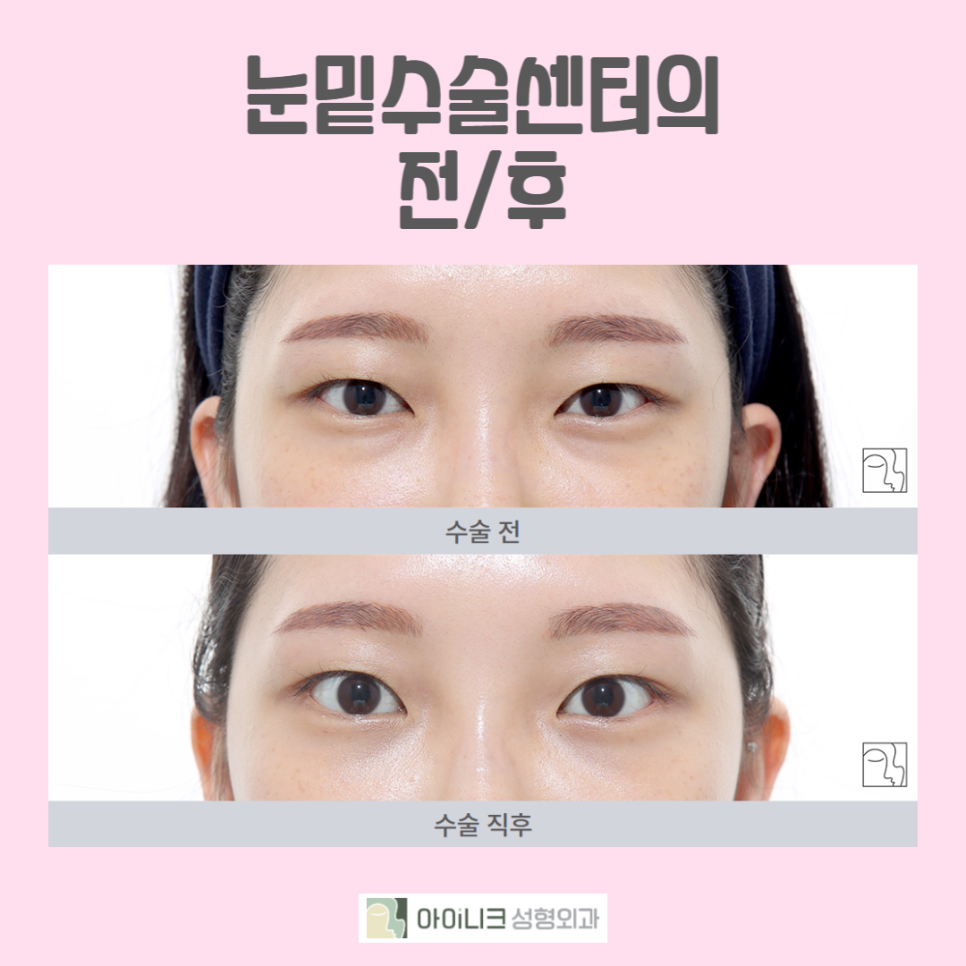 A Brighter Face Again with Under-Eye Surgery image 2