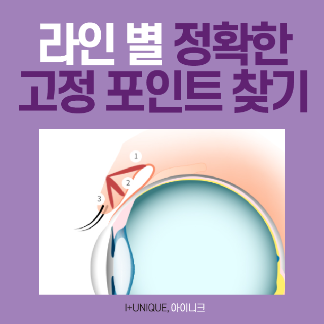 자연스러운쌍수를 위한 아이니크만의 솔루션 대공개 관련 이미지 3