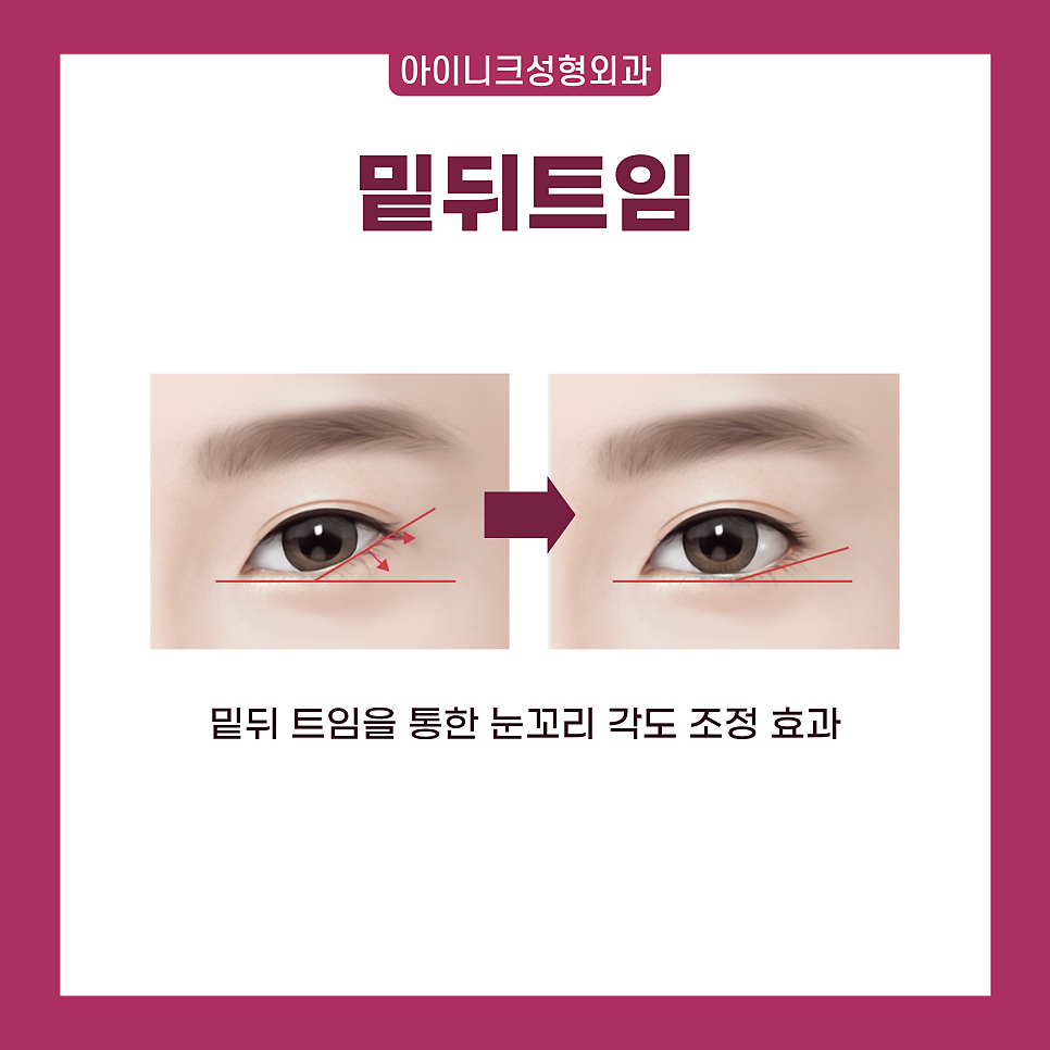 압구정 트임 수술 1위! 자연스럽고 확실한 인상 변화 관련 이미지 7