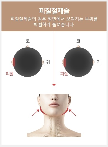 사각턱재건 실패 없이 완성된 얼굴 관련 이미지 4