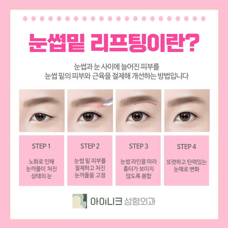 압구정 중년눈성형 시간을 되돌리고 싶다면? 관련 이미지 4