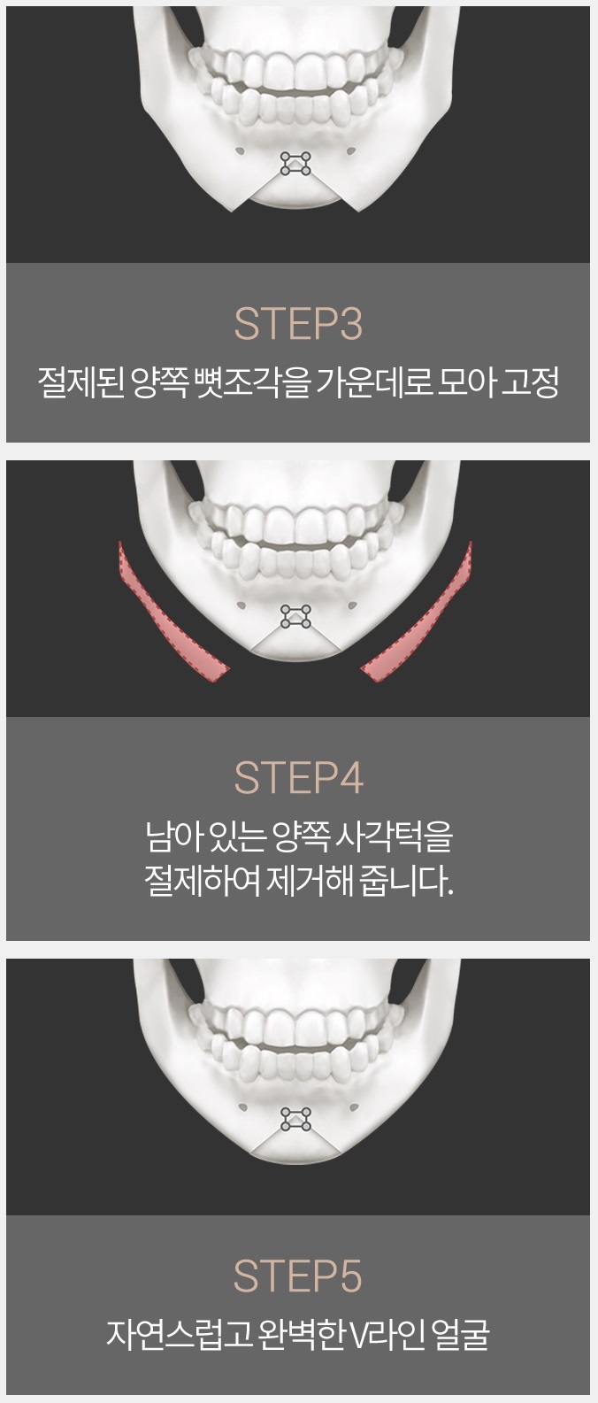 턱끝축소술비용 보다 절골법이 먼저! 관련 이미지 4