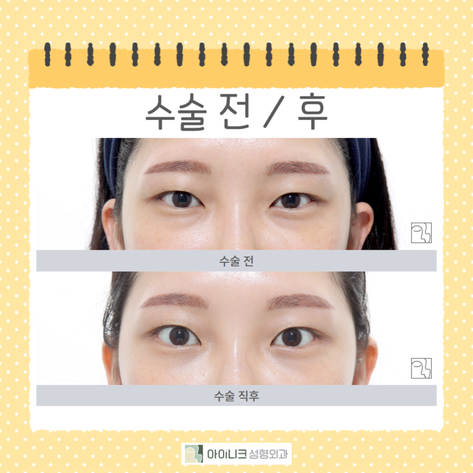 눈밑지방재배치주의사항 꼭 확인하세요! 관련 이미지 2