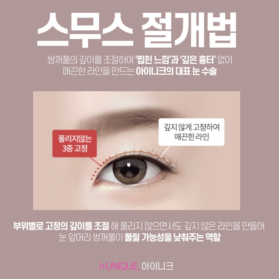 자연스러운 눈꺼풀성형 찾고 있다면 아이니크성형외과로 관련 이미지 3