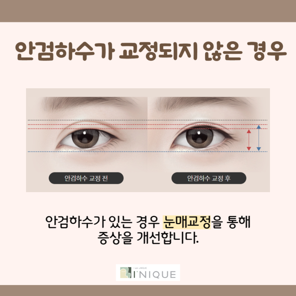 쌍꺼풀재수술잘하는병원은 바로 여기 관련 이미지 3