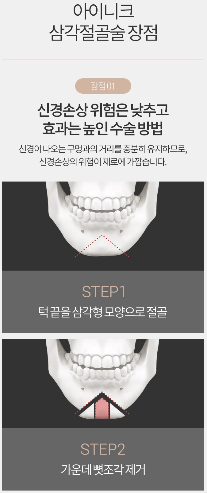 턱끝축소술부작용 없이 안전한 수술 관련 이미지 3
