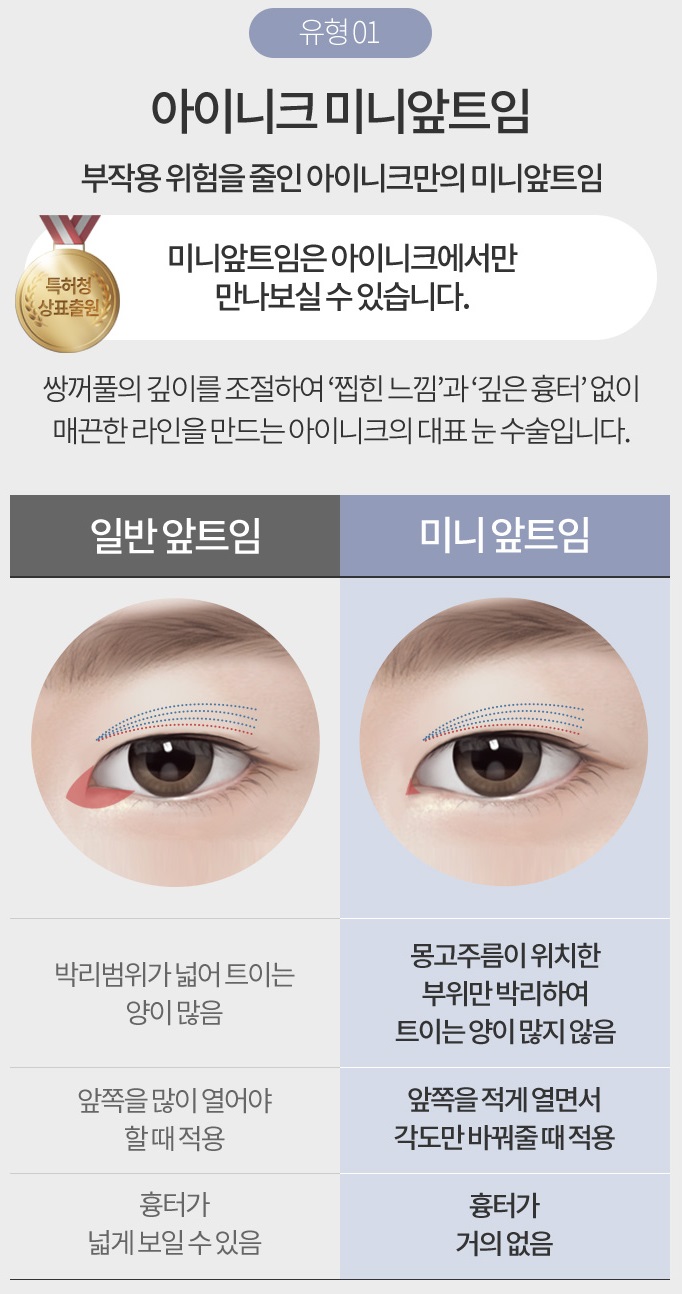 듀얼트임가격 맞춤 성형이 중요해~ 관련 이미지 4