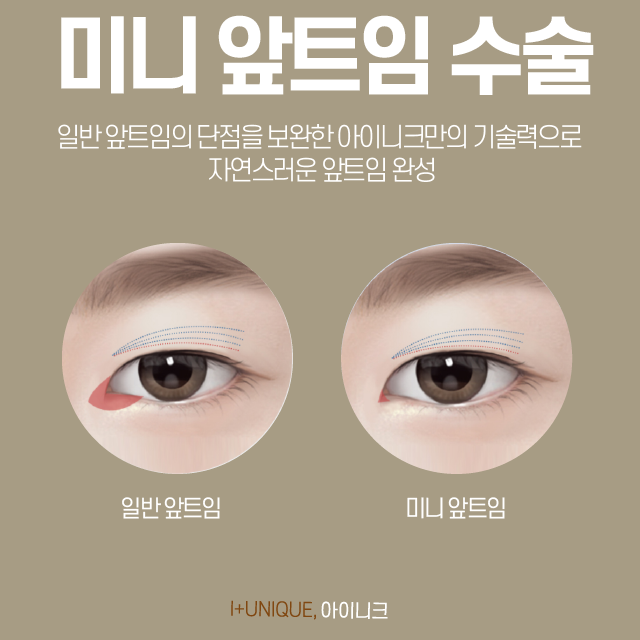 눈트임수술도 제대로 알고 가야 한다 바로 아이니크성형외과 처럼! 관련 이미지 3