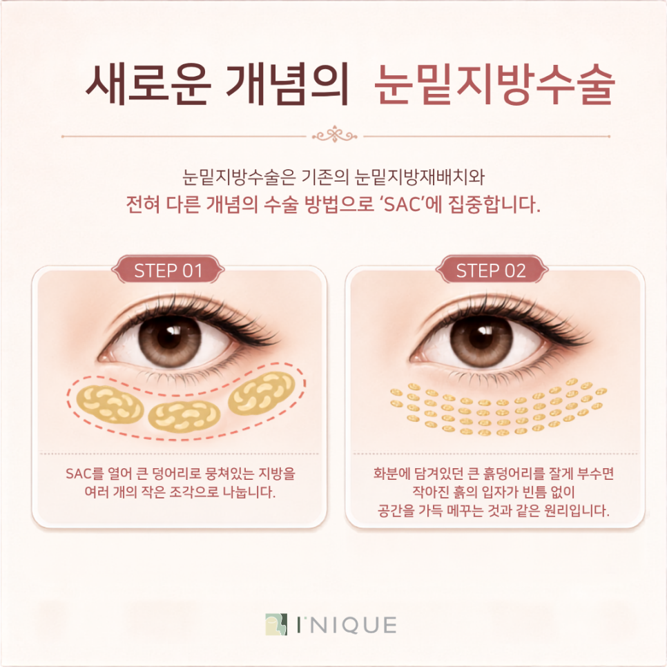 40대 눈밑지 비교 하안검 성형 vs 재배치 어떻게 다를까? 관련 이미지 6