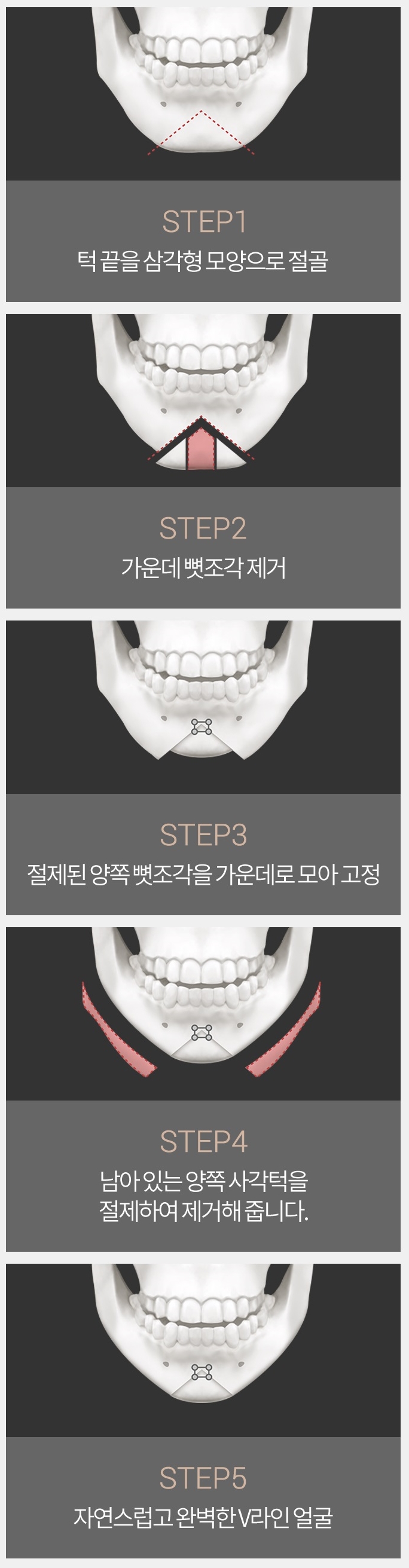 턱끝축소술비용 세련된 내 모습 관련 이미지 5