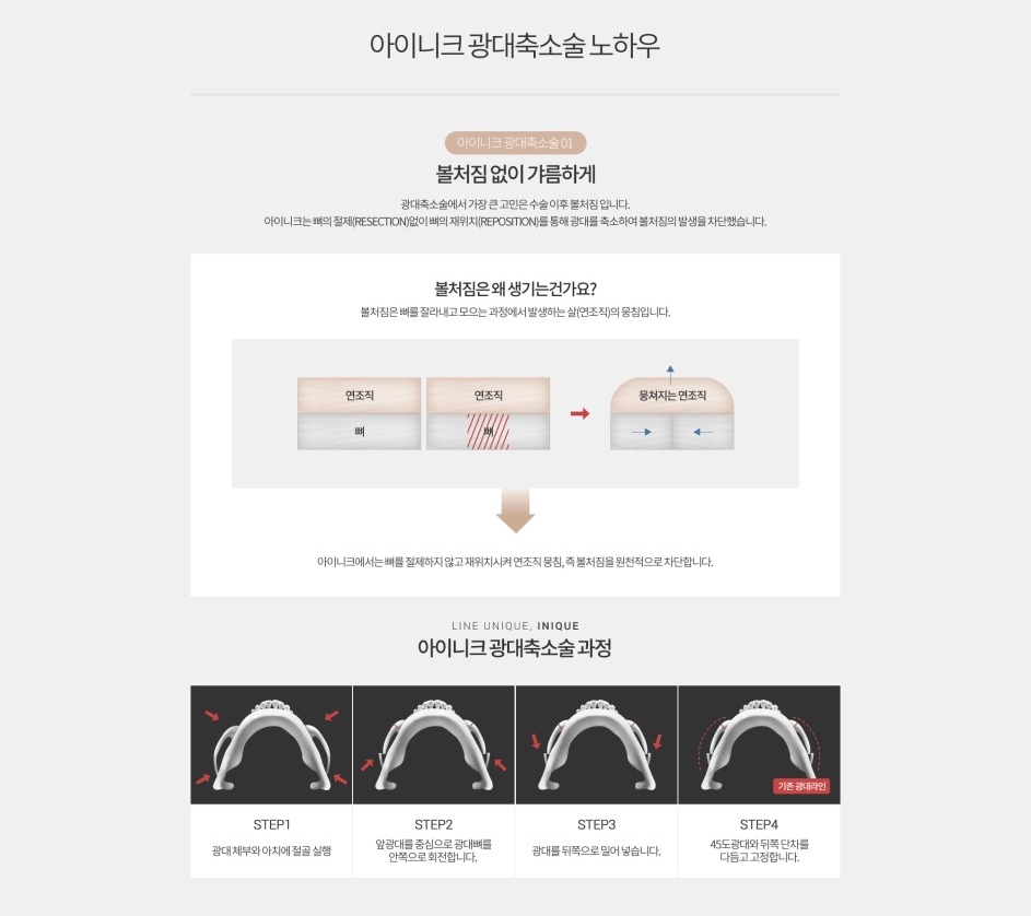 광대축소술비용 주의사항은 무엇일까? 관련 이미지 5
