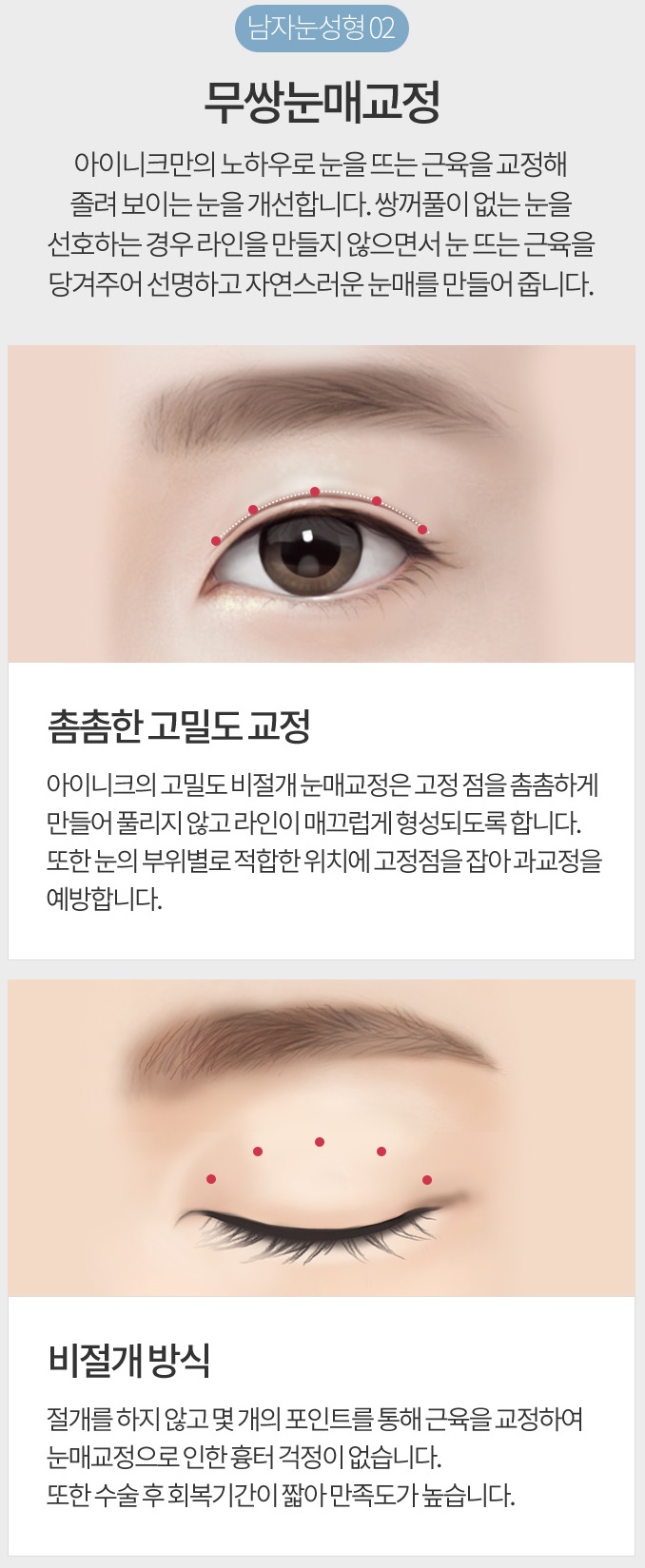무쌍눈매교정술 쌍꺼풀 없이 큰 눈으로 관련 이미지 4